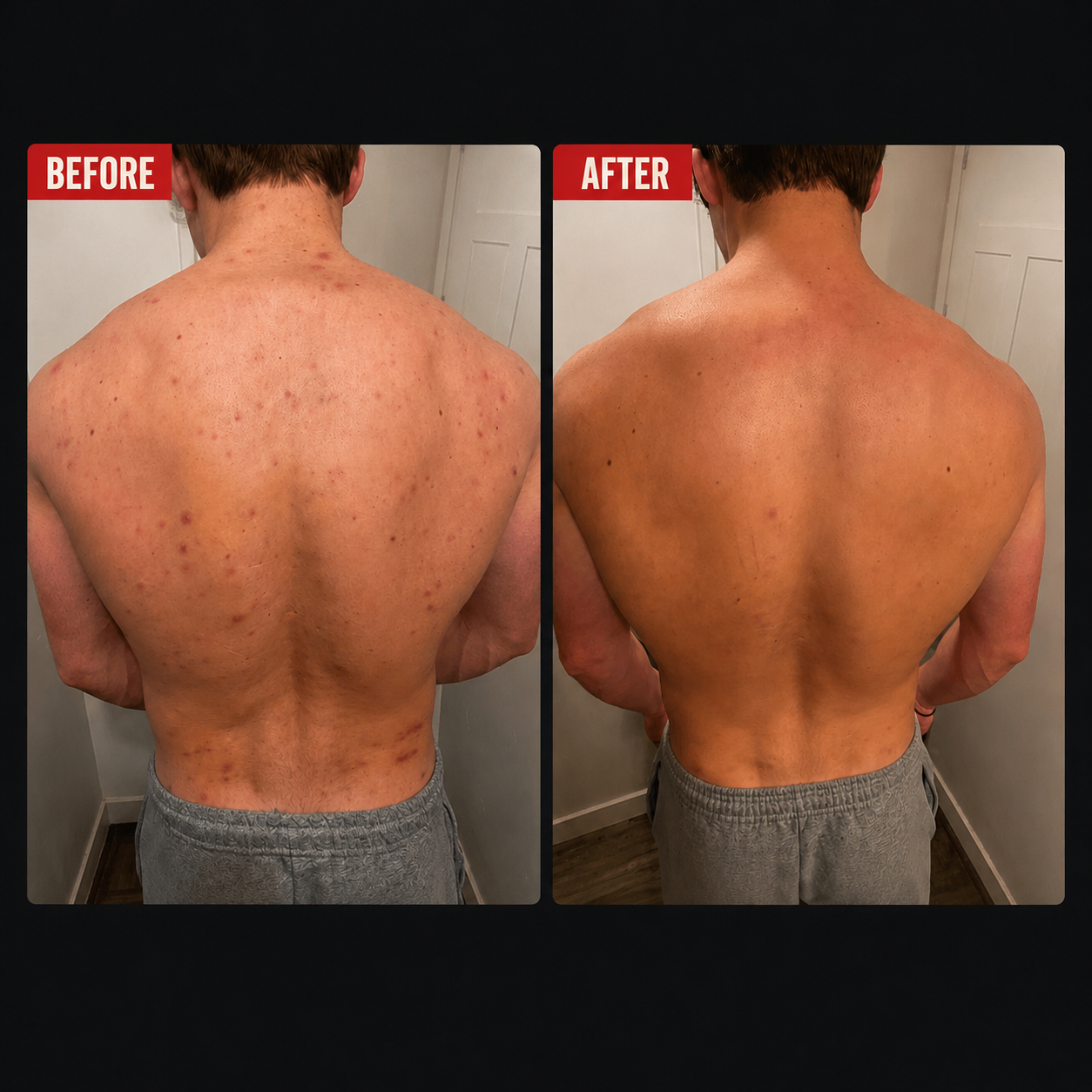 Enzo Face & Body Acne Wipes + Amazing Skincare